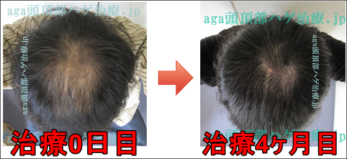 AGA頭頂部治療4ヶ月経過写真
