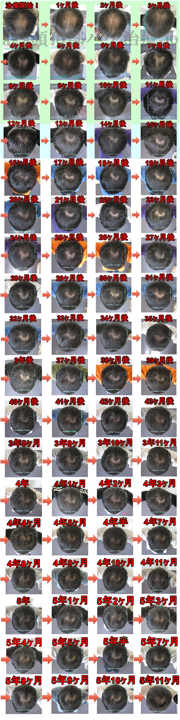 つむじハゲの治療記録画像