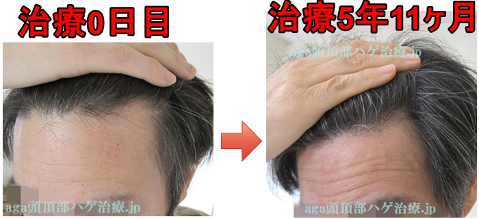 生え際の薄毛の比較画像