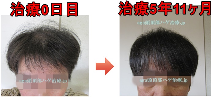 M字の薄毛の比較写真