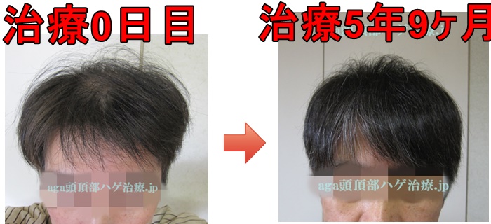 M字の薄毛比較写真