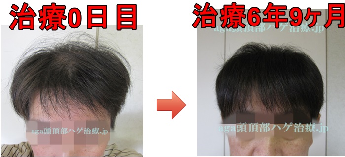 薄毛の改善の比較画像