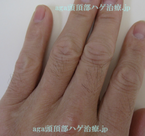 手の指毛