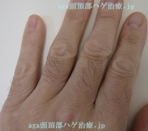 指の毛の写真