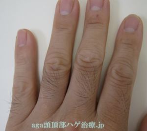 指の毛写真