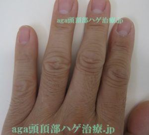 ミノキシジルの副作用で濃くなった指毛