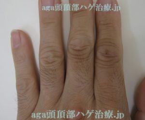 AGA治療薬の副作用で濃くなった指毛