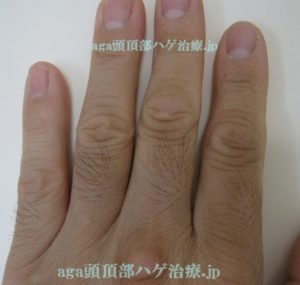 ミノキシジルの副作用で濃くなった指の毛