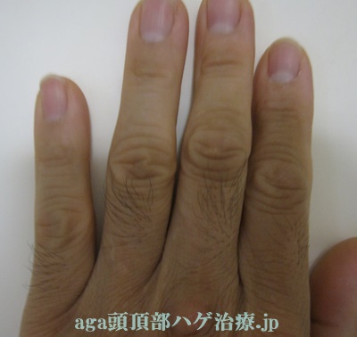 ミノキシジルの副作用で出た指毛