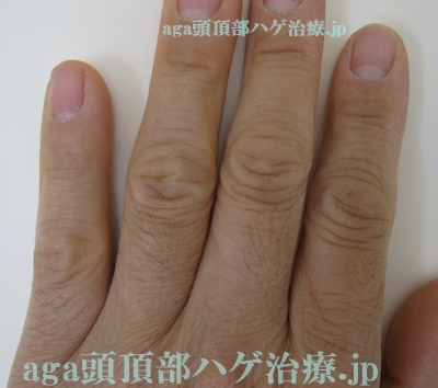 指の毛画像