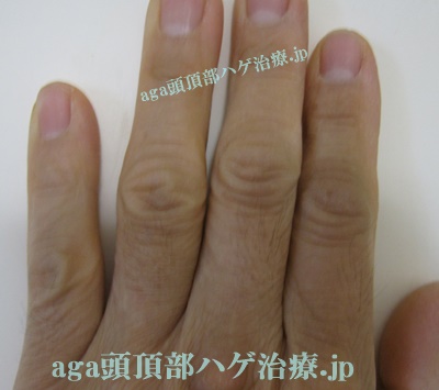 手の指の毛写真