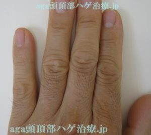 ミノタブの副作用で濃くなった指毛