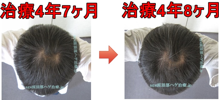 頭頂部の薄毛治療 写真比較