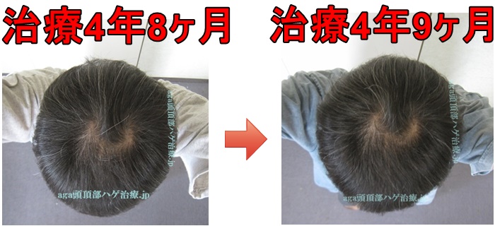 AGA治療頭頂部比較写真