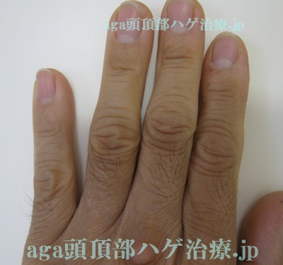 ミノタブの副作用で濃くなった指の毛