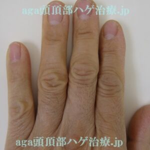 手の指の毛