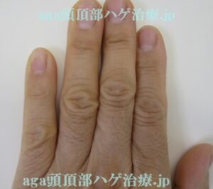 ミノタブで濃くなった手の指の毛