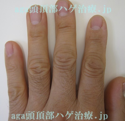 AGA治療薬で濃くなった指の毛