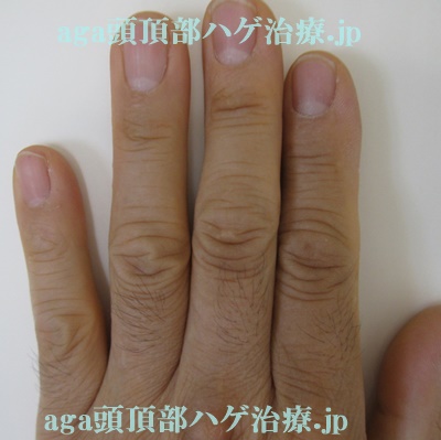 ミノタブで濃くなった指の毛の画像