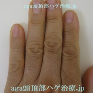 今月の手の指の毛