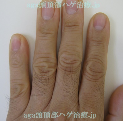 指の毛の写真