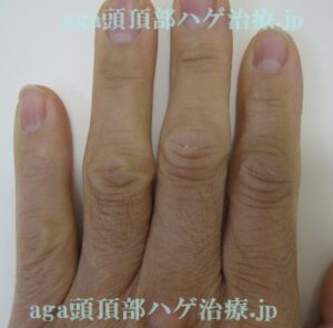 手の指の毛の写真