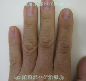 指の毛