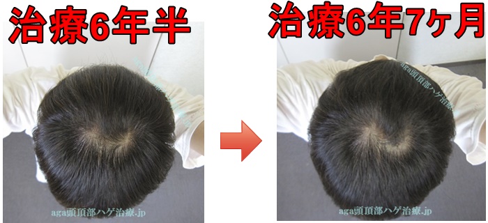 頭頂部の薄毛の写真比較