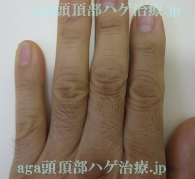 手の指の毛の画像