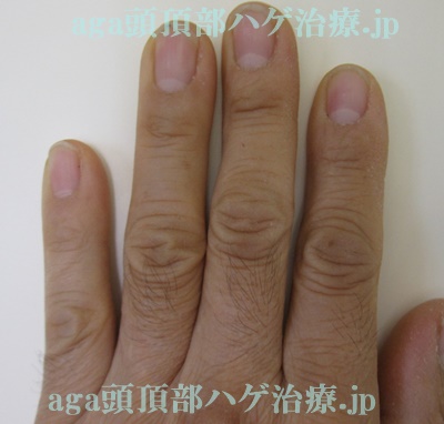 手の指の毛の画像