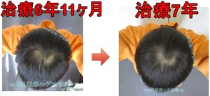 頭頂部の薄毛の比較写真