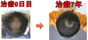 頭頂部のAGA治療の比較写真
