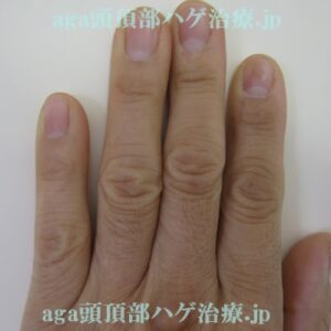 手の指の毛の写真