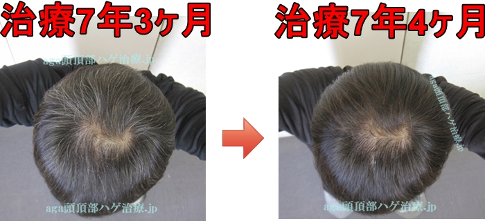 つむじの薄毛治療の比較写真