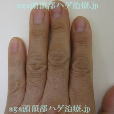 手の指の毛